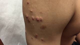 Successful Treatment of Keloid in San Antonio Boerne by Cryo Surgery Texas Institute of Dermatology [upl. by Truda964]