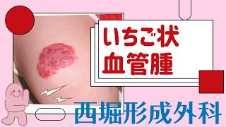 【西堀形成外科】赤あざいちご状血管腫について [upl. by Ramled]