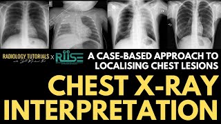 Localising Lesions on Chest Radiographs  A CaseBased Approach  RIISE Workshop [upl. by Morry922]