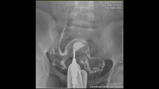 CASE REVIEW hysterosalpingogram HSG [upl. by Learsi538]