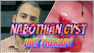 Nabothian Cyst DietWomen’s HealthControlling Ovarian Cyst [upl. by Ameerahs]