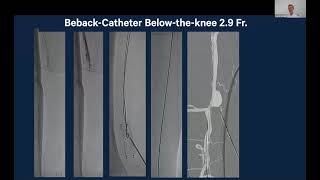 BeBack 29 F used Below The Knee [upl. by Harold]