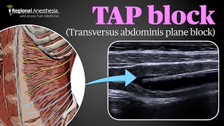 Ultrasound Guided Transversus Abdominis Plane TAP Block [upl. by Edsel]