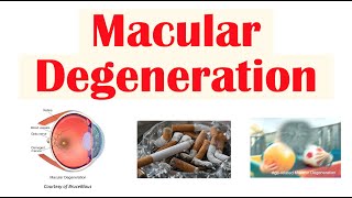 Macular Degeneration  Wet vs Dry  Risk Factors Pathophysiology Symptoms Diagnosis Treatment [upl. by Eeima242]