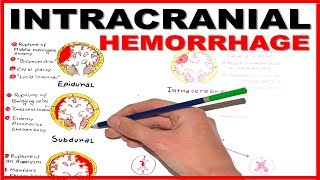 Intracranial Hemorrhage EpiduralSubduralSubarachnoid overview [upl. by Natale]