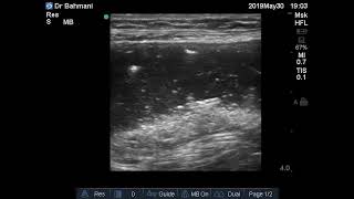 Case 151  Bowel obstruction  ToandFro [upl. by Adnuhsat297]