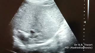 Chronic Liver Disease Ultrasound [upl. by Lani]