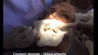 Cosmesi dentale Sbiancamento [upl. by Enileme]