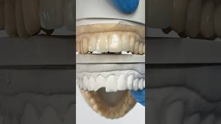 Working to replace a chipped tooth ​⁠EnvisiontecMain envisiontec lsk121shorts dentist teeth [upl. by Anivlem]