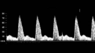 DOPPLER ARTERIA UTERINA [upl. by Eelanna]