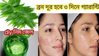 I applied👆🏻this DIY Neem Gel on Acne Pimples PigmentationBumps  Got Clear Glowing Skin In 3 Days [upl. by Aerdnaek]