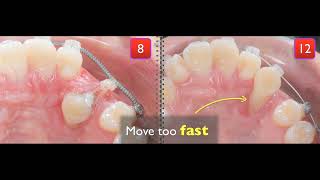 Treatment of palatal impaction [upl. by Traver]