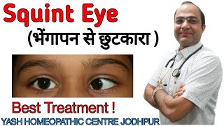 Squint eye treatment  strabismus crossed eye treatment without surgery  भेंगापन से छुटकारा [upl. by Nnylylloh]