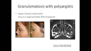 ANCA Vasculitis A Rheumatologists Perspective by Padmapriya Sivaraman MD [upl. by Chatav]