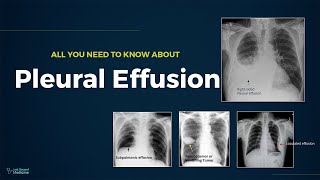 Pleural Effusion  Types Causes Evaluation amp Management All You Need To Know For Exam [upl. by Aihsak]