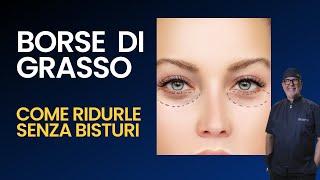 BORSE DI GRASSO SOTTO GLI OCCHI  Dott Masolini Alessandria [upl. by Hepsoj493]