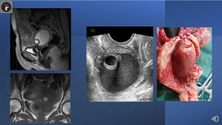 A CYSTIC ENDOMETRIAL POLYP OR A SUBMUCOUS FIBROID WITH CYSTIC DEGENERATION [upl. by Rundgren]