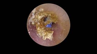 Earwax and Grommet Removal [upl. by Aneerb470]