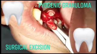 Conservative Approach of Oral pyogenic granuloma surgical excision benign exophytic and vascular [upl. by Inilahs]