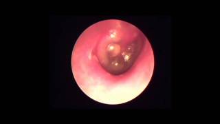 Ear pain at night  Common cold causes AOM [upl. by Jenei234]