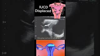 Displaced IUCD Causes Diagnosis and Management shortsbeta yt healthytips DrSaimakhan [upl. by Rasec]