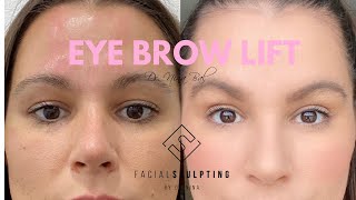 BROW LIFT 3MONTH POSTOP RESULTS  DR TANVEER JANJUA  NEW JERSEY [upl. by Ilke]