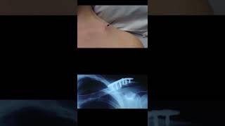 Broken Collarbone Clavicle Fracture [upl. by Ebbarta510]