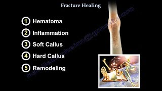 Fracture Healing  Everything You Need To Know  Dr Nabil Ebraheim [upl. by Wrightson]