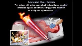 Malignant Hyperthermia  Everything You Need To Know  Dr Nabil Ebraheim [upl. by Arahset]