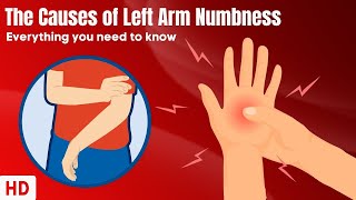 The Causes Of Left Arm Numbness [upl. by Punak659]