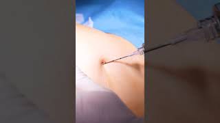 Contour your body in nonsurgical way with Lucia’s Butt fillers [upl. by Aidile199]