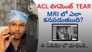 ACL Tear  How to see on MRI Knee ligament tear  Knee instability  Dr Ramprasad Kancherla [upl. by Kienan]