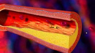 videoaboutcomThrombosis  What Is Thrombosis  Dangers of Arterial Plaque Videomp4 [upl. by Ylle]