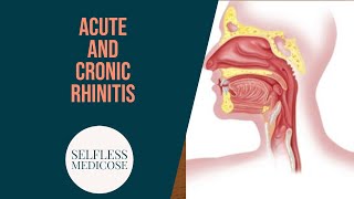 CHRONIC RHINITIS part 2 hypertrophic rhinitis easy explanation [upl. by Kneeland]