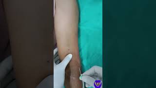 how to cannulation fistula  Hemodialysis parmanent Access  AV fistula cannulation dialysis [upl. by Trace692]