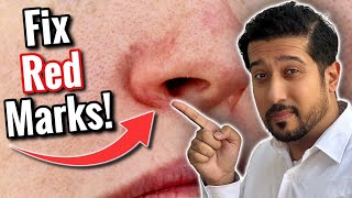 Redness Around Nose  Get Rid of Perioral Dermatitis FAST [upl. by Tindall420]