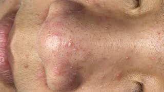 Nose Blackheads removal  Acne Treatment LyLy Beauty Spa 014  2024 [upl. by Qahsi]