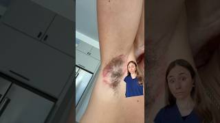 Deodorant Rash Gone Wrong  Must See [upl. by Rubel]