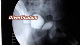 Hutchs diverticulum [upl. by Reppart]