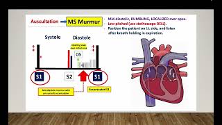 Mitral stenosis  Omar Layth  Cardiology made easy [upl. by Nylloh]