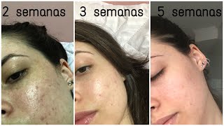 TRATANDO ACNE  Minha experiência com ADAPALENO [upl. by Odo]