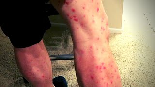 One Year Without Cosentyx and my Psoriasis is BACK [upl. by Eelyac]