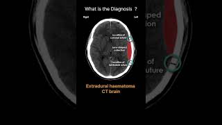 Extradural haematoma  CT brain Acute CT Brain Extraaxial haemorrhage 64 radiologychannel007 [upl. by Licec]