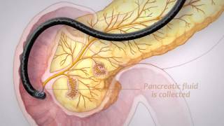 Pancreatic Cancer Screening [upl. by Ahsok]