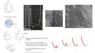 Left ventricular catheterization including AS and left ventriculography Diagrams and cases [upl. by Ijan]