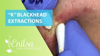 quotKquot Blackhead Extractions [upl. by Drofhsa]