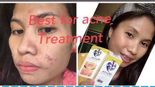 THE BEST FOR ACNE TREATMENT THE T3 MYCIN CLINDAMYCIN LOTION [upl. by Dnomyad]