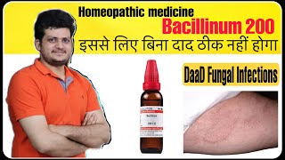 Best Homeopathic Medicine for Fungal Infection Ringworm or tinea corporis  Bacillinum 200 [upl. by Ahsilad]