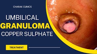 Umbilical Granuloma treatment with single application of Copper Sulphate [upl. by Ytirev]