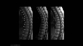 imaging of Spine tumors [upl. by Eiramrebma]